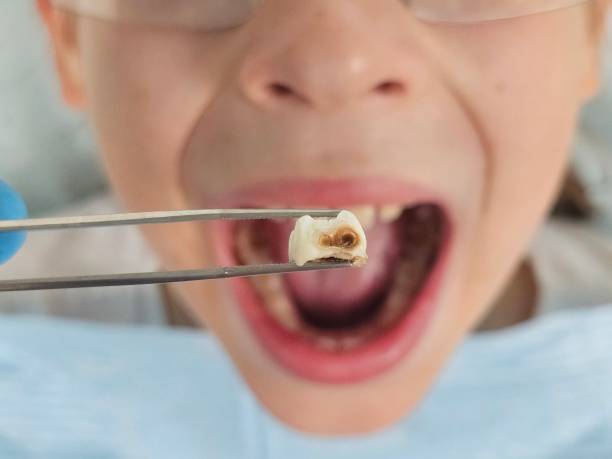 Best Emergency Root Canal Treatment in Rosedale, WA